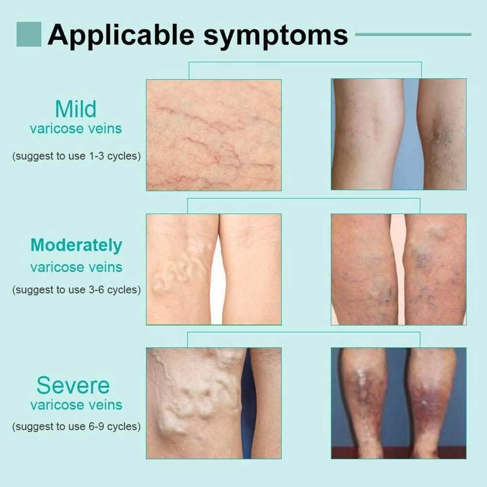 AnYi Beauty Varicose Vein Cream, Deep Nourishing Soothing Cream For Leg Beauty & Personal Care - DailySale