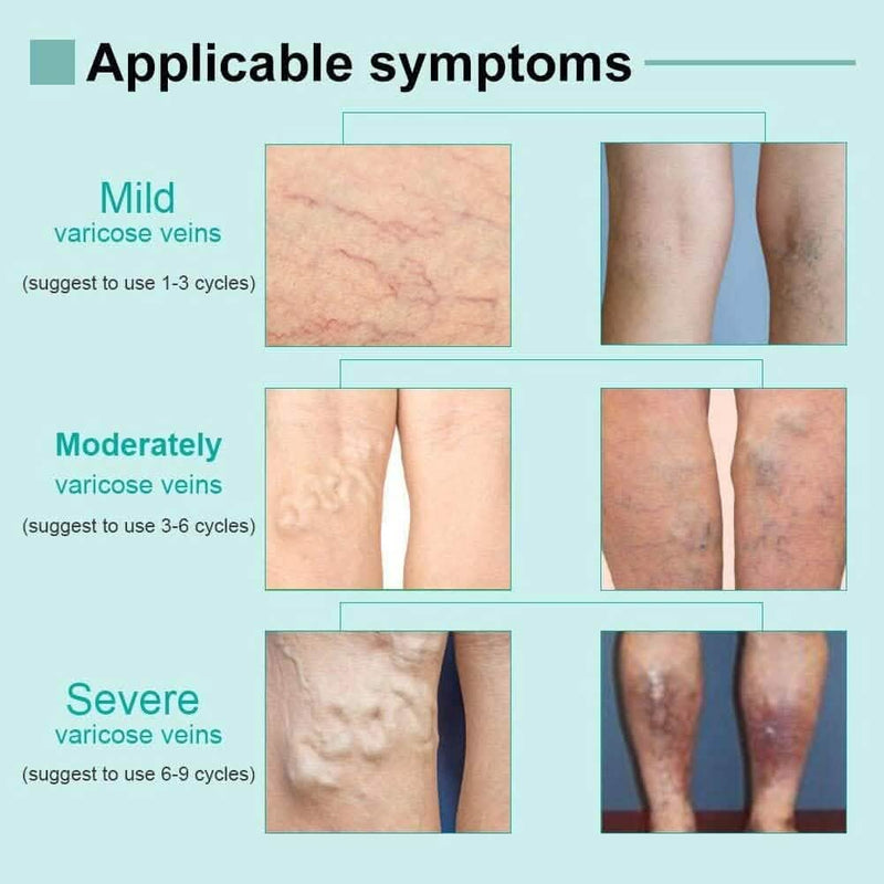AnYi Beauty Varicose Vein Cream, Deep Nourishing Soothing Cream For Leg Beauty & Personal Care - DailySale