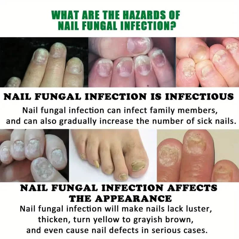 Ginger Nail Care Liquid Onychomycosis Fungus Repair Hand and Foot Nail Care Beauty & Personal Care - DailySale