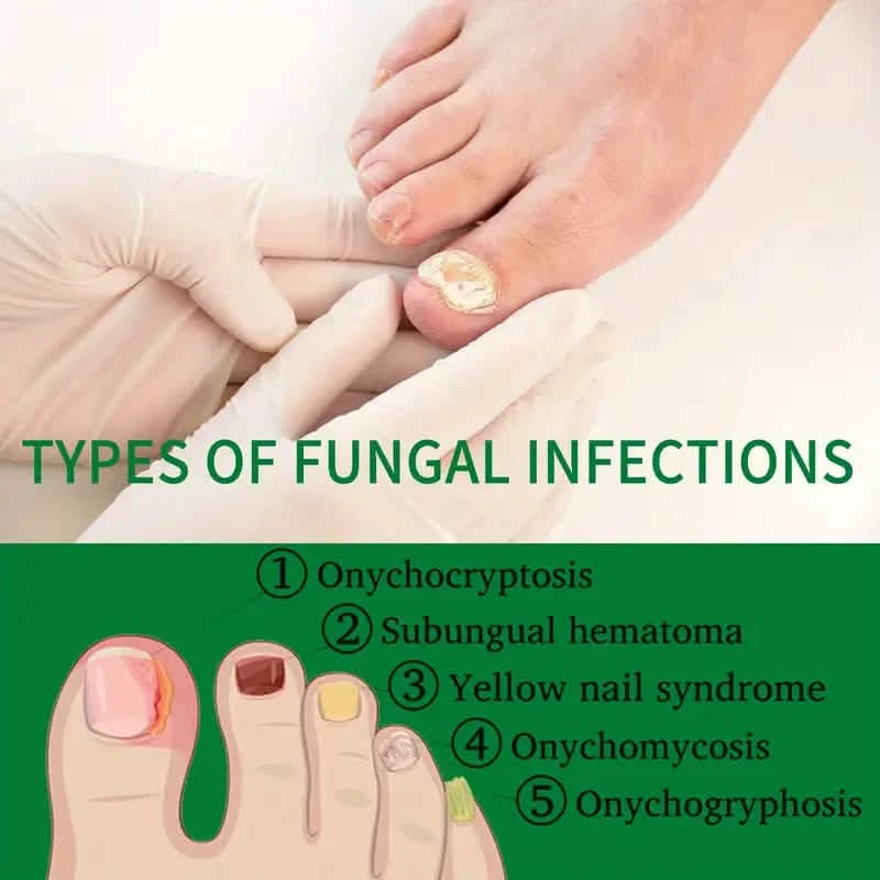 Ginger Nail Care Liquid Onychomycosis Fungus Repair Hand and Foot Nail Care Beauty & Personal Care - DailySale