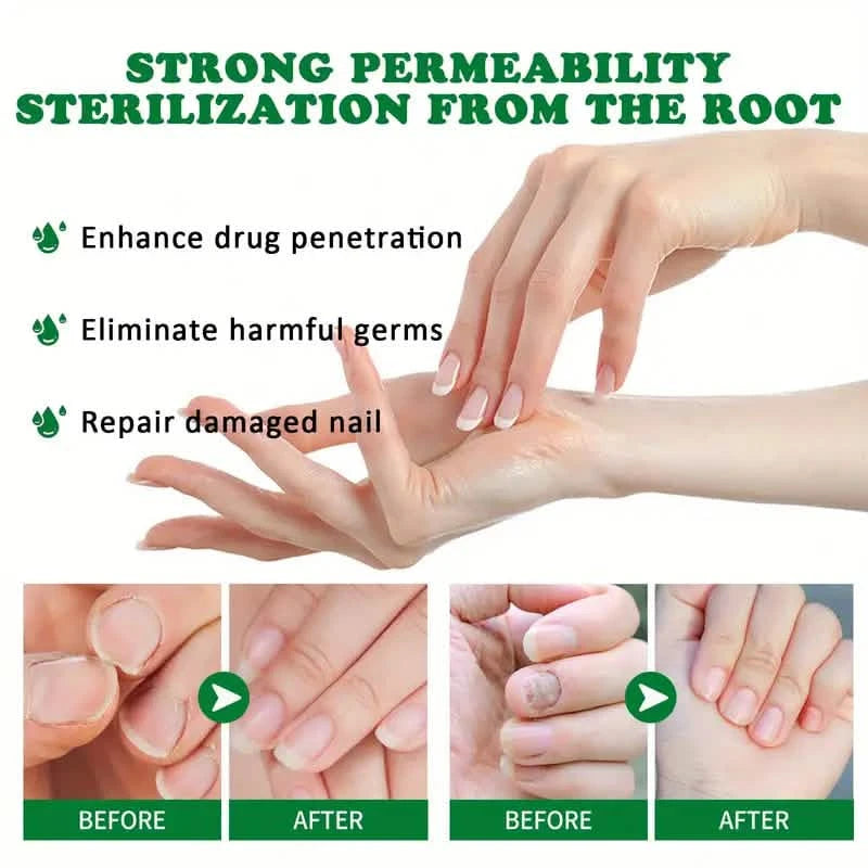 Ginger Nail Care Liquid Onychomycosis Fungus Repair Hand and Foot Nail Care Beauty & Personal Care - DailySale