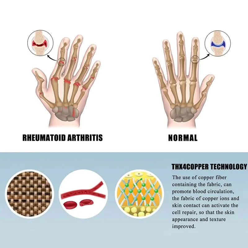 Diagram demonstrating a hand with reumathoid arthritis versus a normal hand