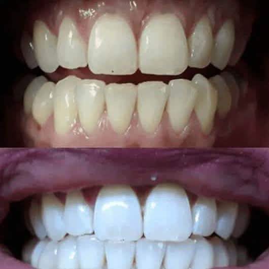 TrueWhite Advanced Plus 2 Person Whitening System Beauty & Personal Care - DailySale