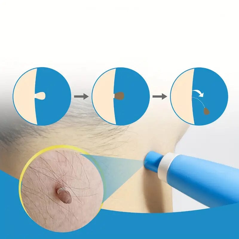 2-8mm Advanced Auto Skin Tag Repair Kit Beauty & Personal Care - DailySale