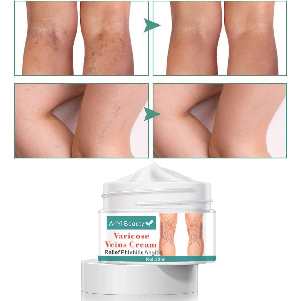 AnYi Beauty Varicose Vein Cream, Deep Nourishing Soothing Cream For Leg Beauty & Personal Care - DailySale