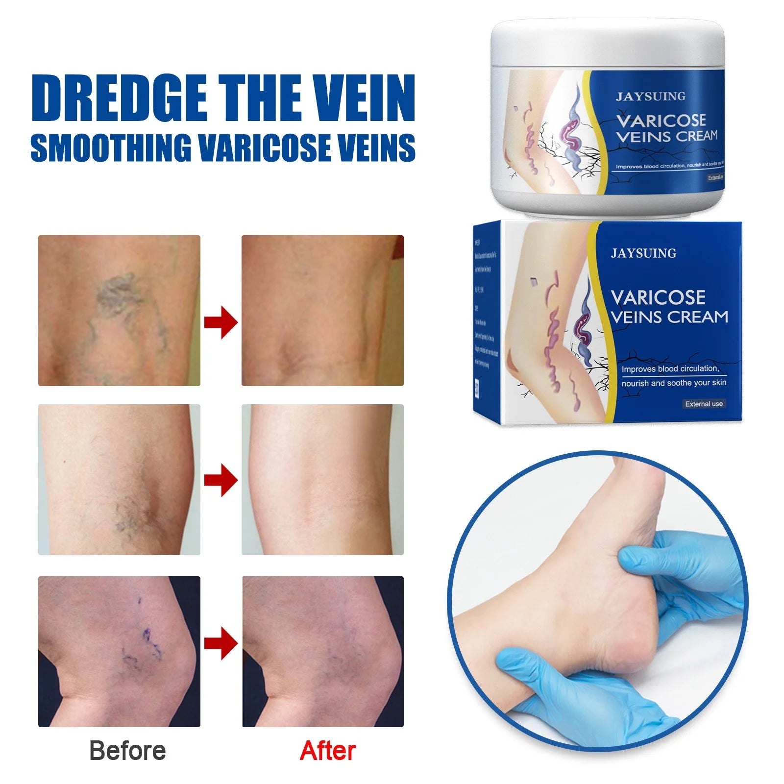 Pain Relief Leg Spider Veins Vasculitis Promote Circulation Smooth Metabolism 30g Exfoliation Beauty & Personal Care - DailySale