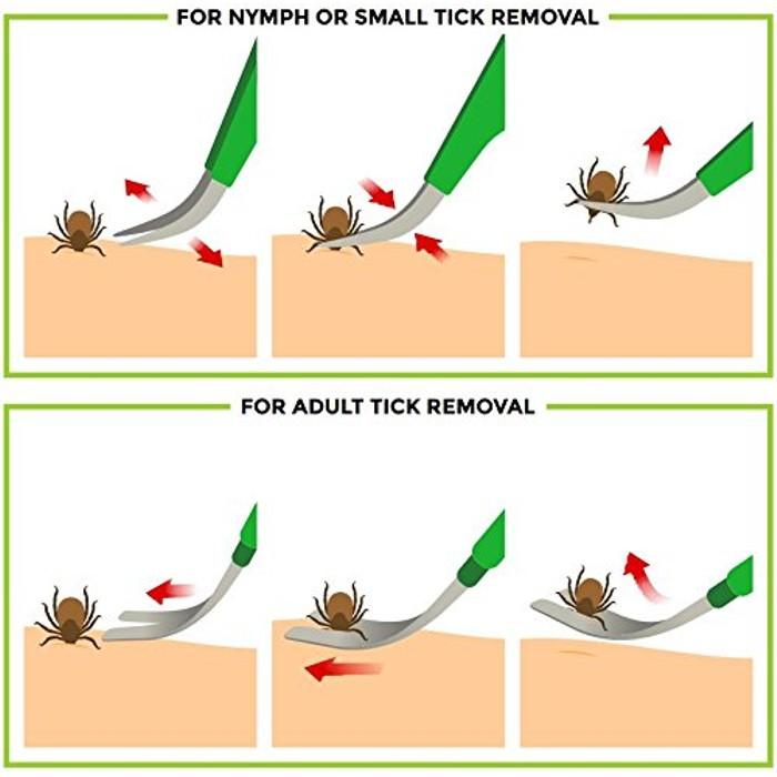 2-Pack: BritenWay Stainless Steel Tick Remover Set Pet Supplies - DailySale