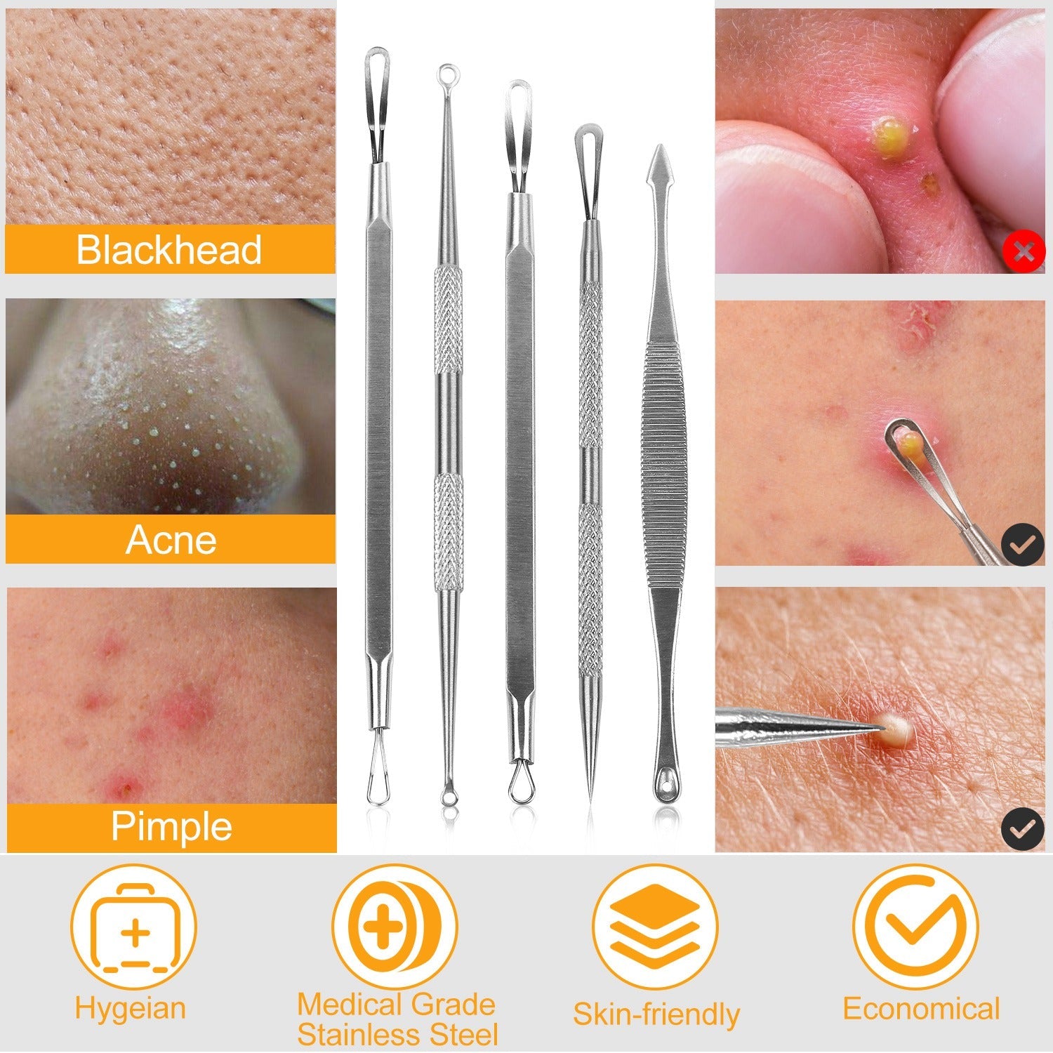 5-Piece Set: Blackhead Remover Kit Stainless Steel Popping Zit Remover Beauty & Personal Care - DailySale