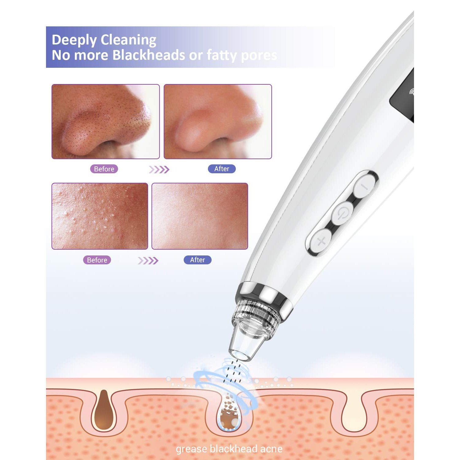 Blackhead Pore Vacuum Cleaner Remover Beauty & Personal Care - DailySale